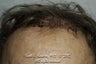 AccuGraft Hair Transplant