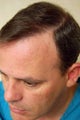 Hair Transplantation