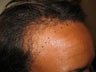 Hair Transplantation