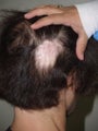 Hair Transplant to Prior Scar