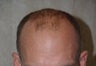 Hair Transplant 2000 grafts
