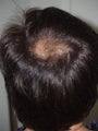 Hair Transplant 