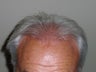 Hair Transplant