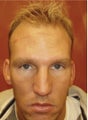Hair Transplant