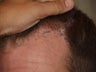 Reparative Hair Transplant