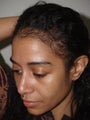 Hair Transplant