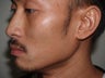 Facial Hair Transplant
