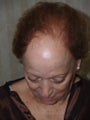 Hair Transplant
