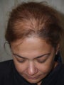 Hair Transplant