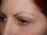 Eyebrow Transplants