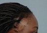 Hair Transplantation