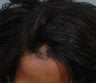 FUE Hair Transplantation
