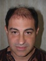 Hair Transplant- 2500+ Grafts