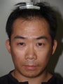 Hair Transplant 