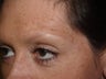 Eyebrow Transplant