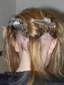 Hair Tansplant