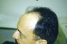 Hair Transplant