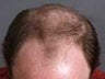 Hair Transplant