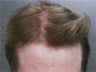 Hair Transplant