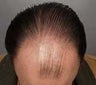 Hair Transplant