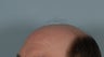 Hair Transplant