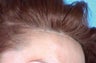 Hair Transplant