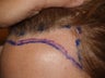 Surgical Hairline Advancement