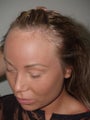 Before and After Surgical Hairline Advancement