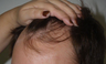 Hair Transplant