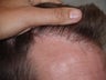 Reparative Hair Transplant