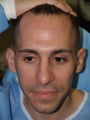 Hair Transplant FUE 