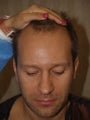 Hair Transplant (FUM)