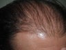 Hair Transplant (FUM)
