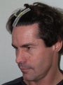 Repair of Fleming-Meyer Scalp Flap