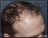 Hair Transplant