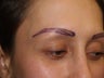 Hair Transplant - Eyebrows