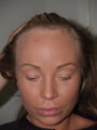 Surgical Hairline Advancement Procedure