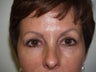 Eyebrow Transplant Procedure