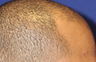 Hair Transplant