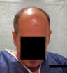 Hair  Transplantation with power FUE Technique