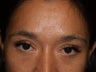 Before, Immediately After, and 1 Year After Eyebrow Transplant Procedure