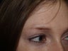 Before and After Eyebrow Hair Transplant