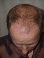 Before, 5 days after, and 10 months after hair transplant procedure