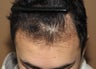 FUE /Neograft hair transplant