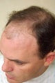 Hair Transplantation