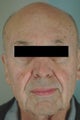 Pulsed Dye Laser Treatment for Rosacea 