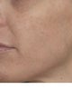 Alexandrite and IPL (Intense pulsed light)  treatment