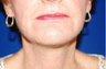Facelift, Intense Pulsed Light 