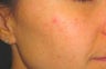 IPL for Acne