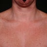 IPL for Chest